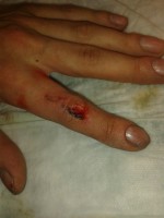 Finger Kaputt
